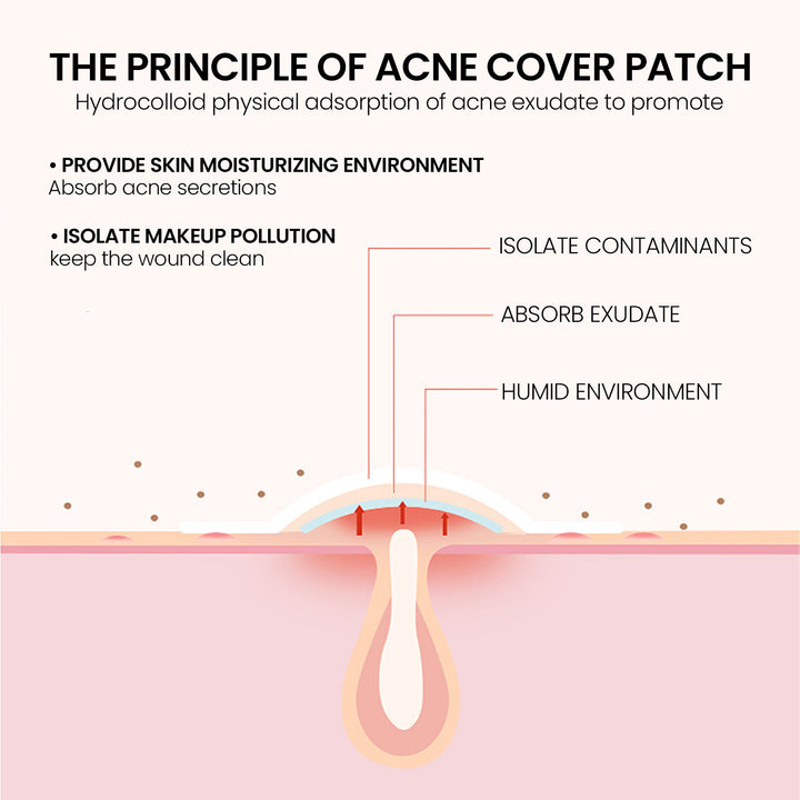 Repair Acne Patch applied on whitehead acne close-up skin detail